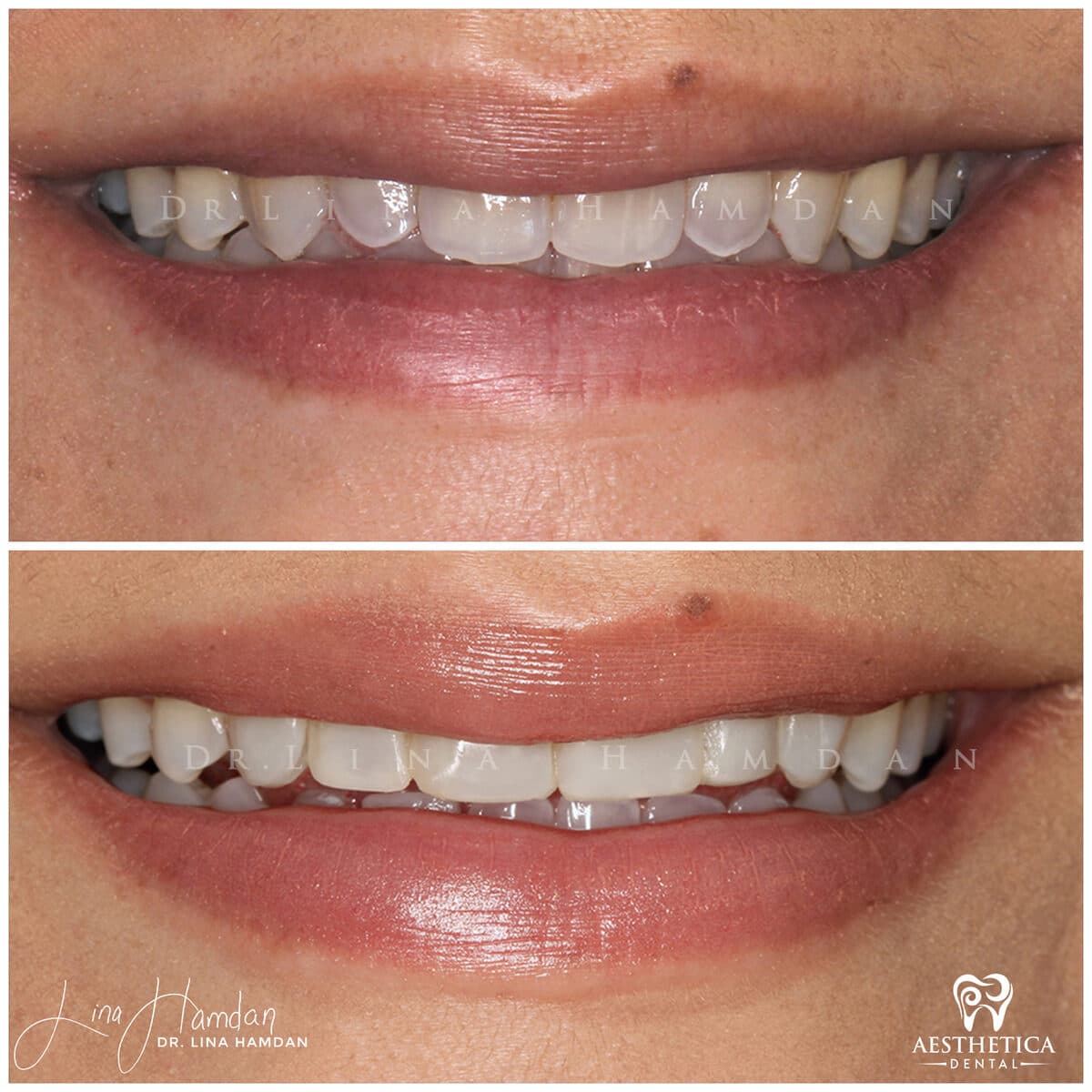 Composite bonding: anonymous case 99 from Aesthetica Dental Naperville