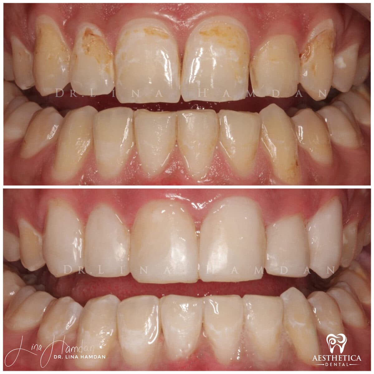 Composite bonding: anonymous case 100 from Aesthetica Dental Naperville