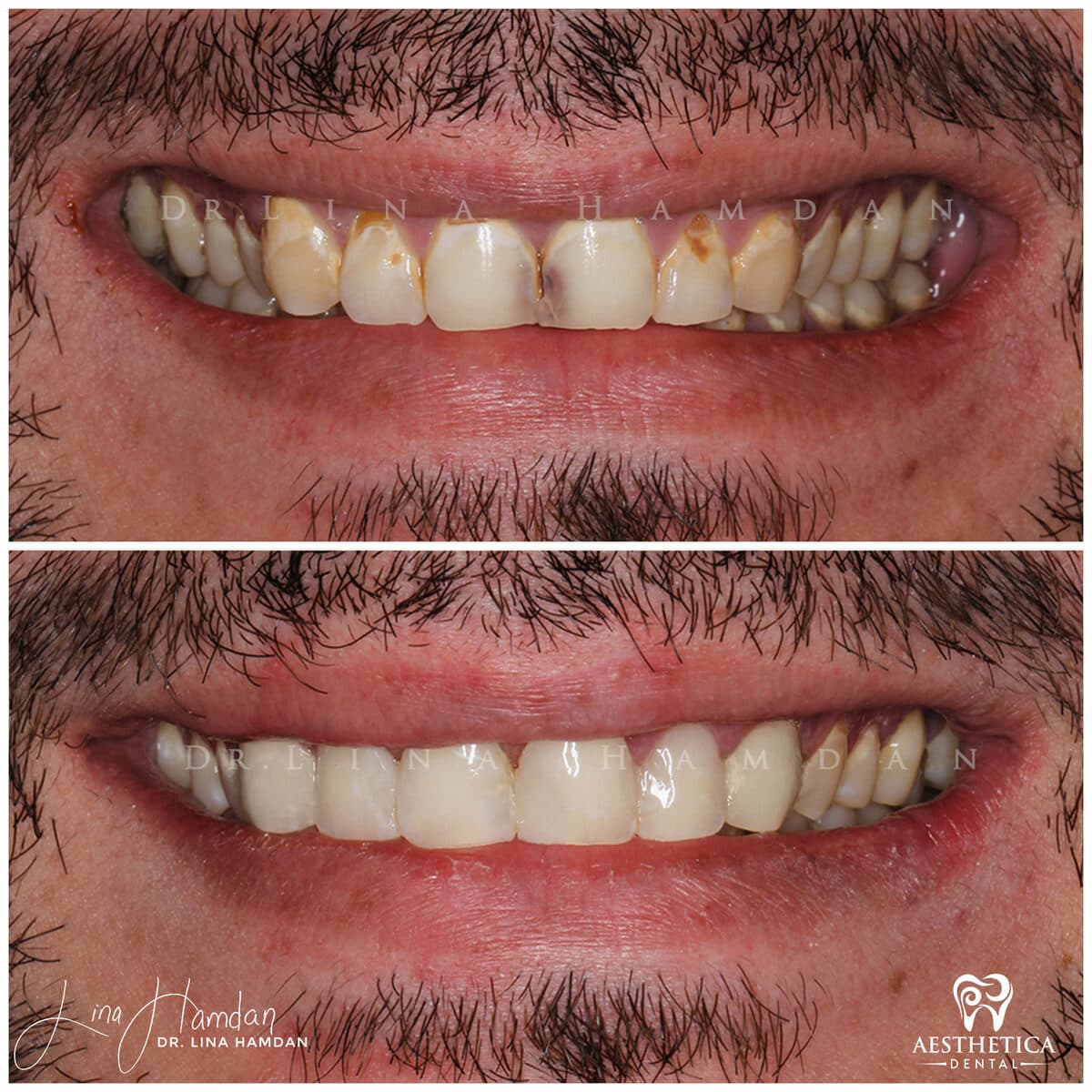 Composite bonding: anonymous case 101 from Aesthetica Dental Naperville