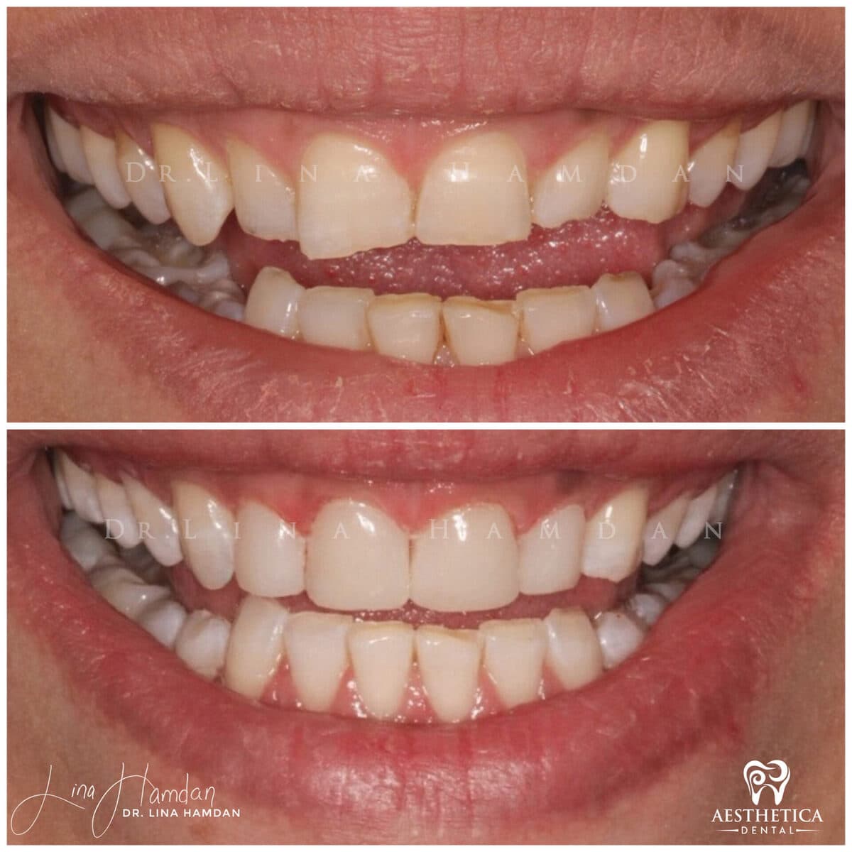 Composite bonding: anonymous case 102 from Aesthetica Dental Naperville