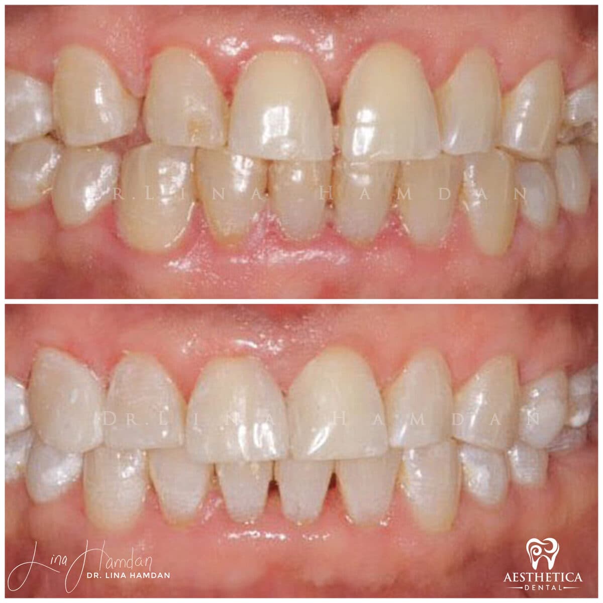 Composite bonding: anonymous case 105 from Aesthetica Dental Naperville