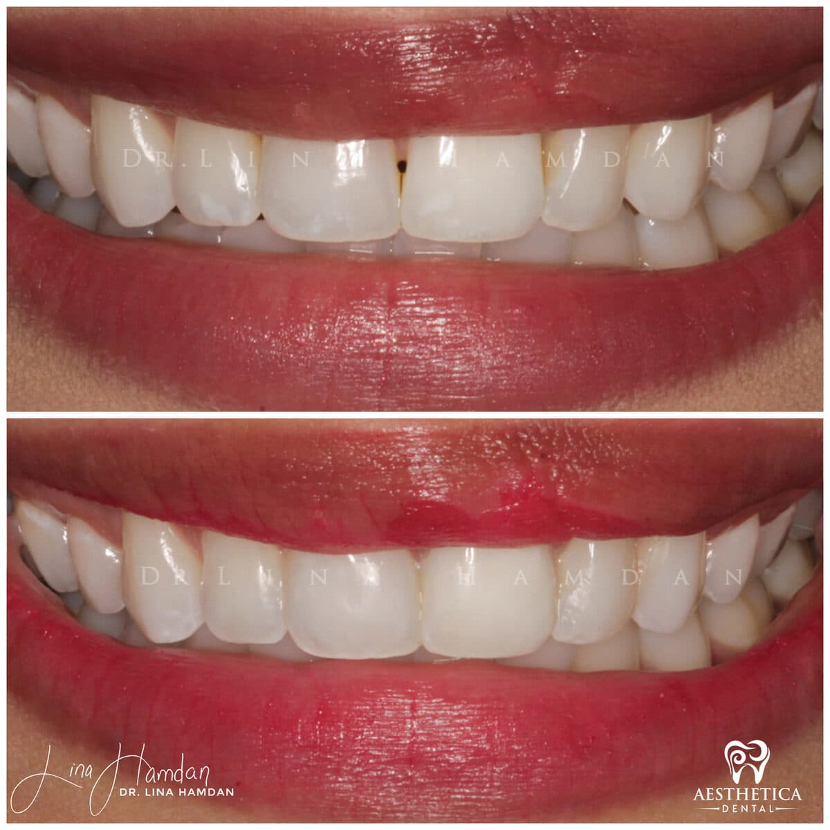 Composite bonding: anonymous case 106 from Aesthetica Dental Naperville