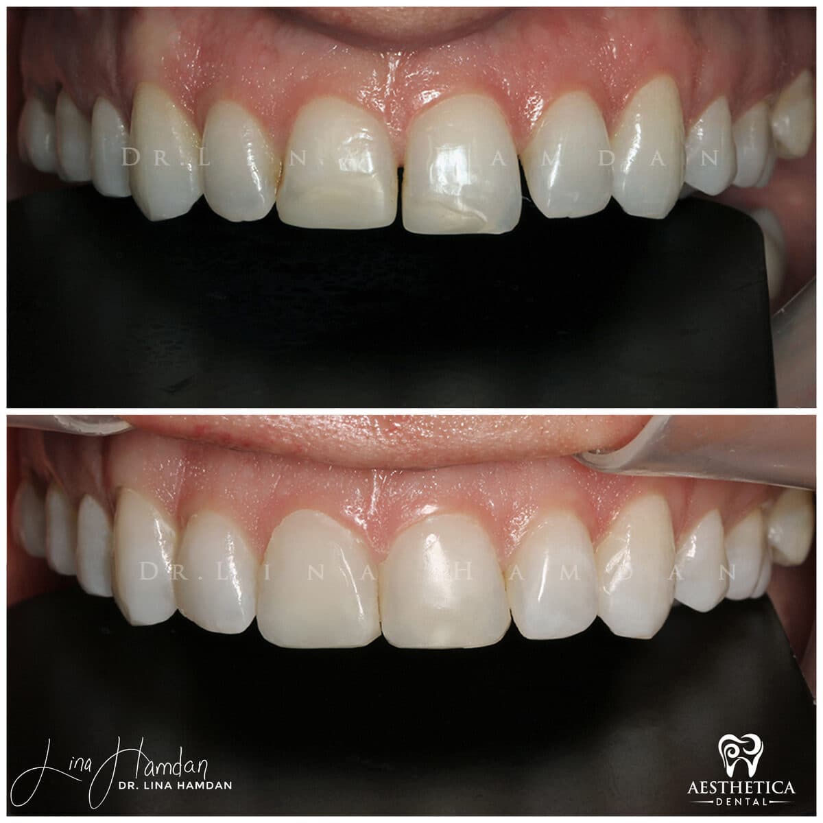 Composite bonding: anonymous case 110 from Aesthetica Dental Naperville