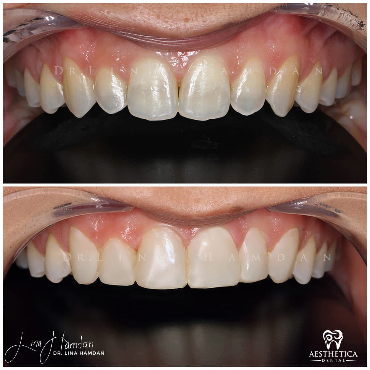 Composite bonding: anonymous case 112 from Aesthetica Dental Naperville