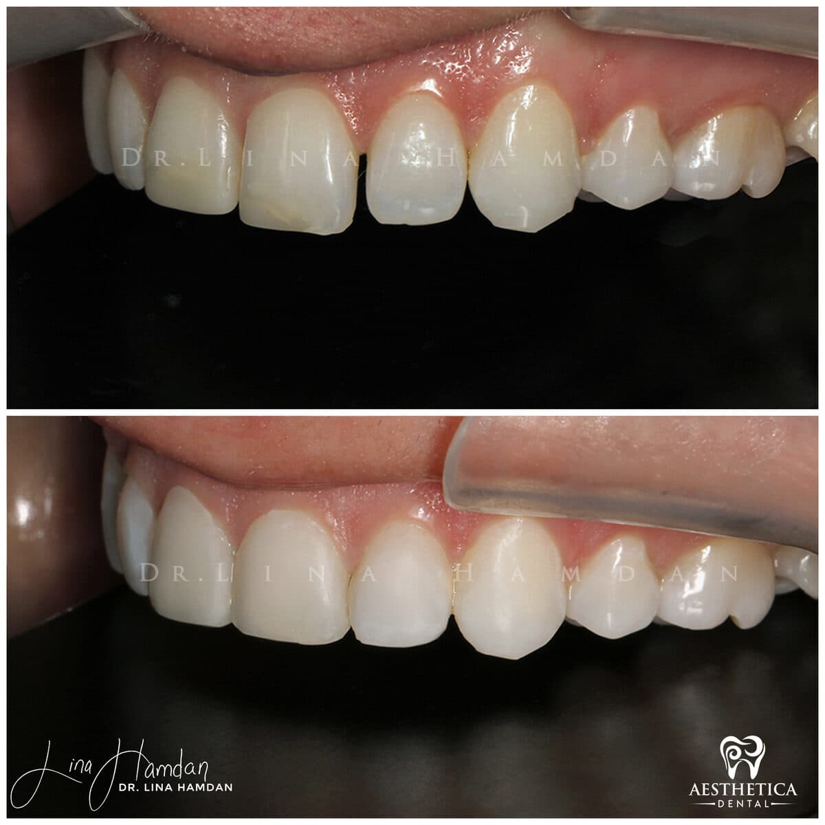 Composite bonding: anonymous case 113 from Aesthetica Dental Naperville