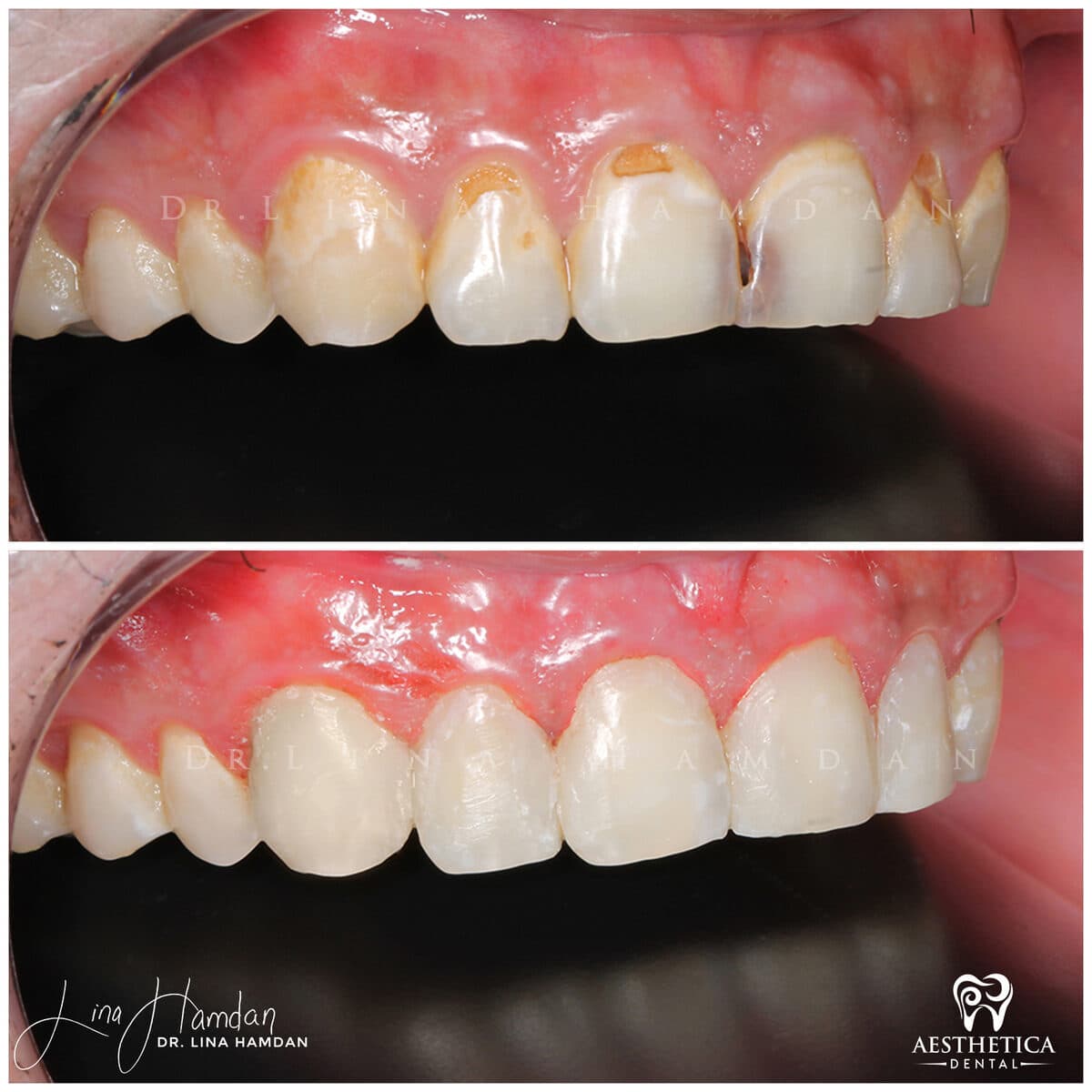 Composite bonding: anonymous case 115 from Aesthetica Dental Naperville