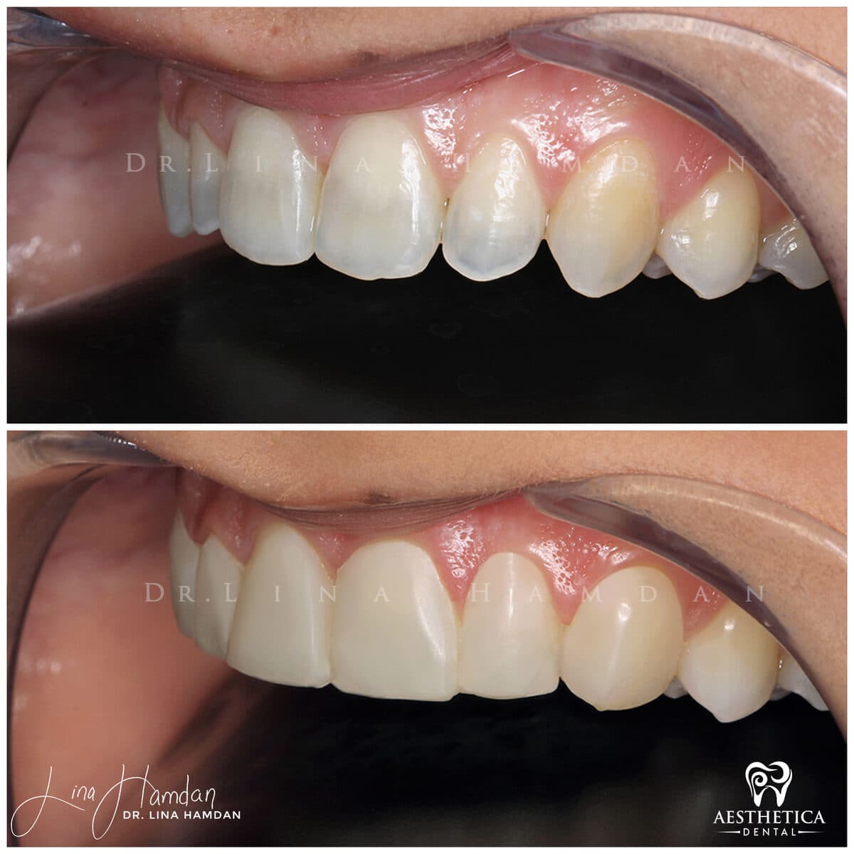 Composite bonding: anonymous case 116 from Aesthetica Dental Naperville