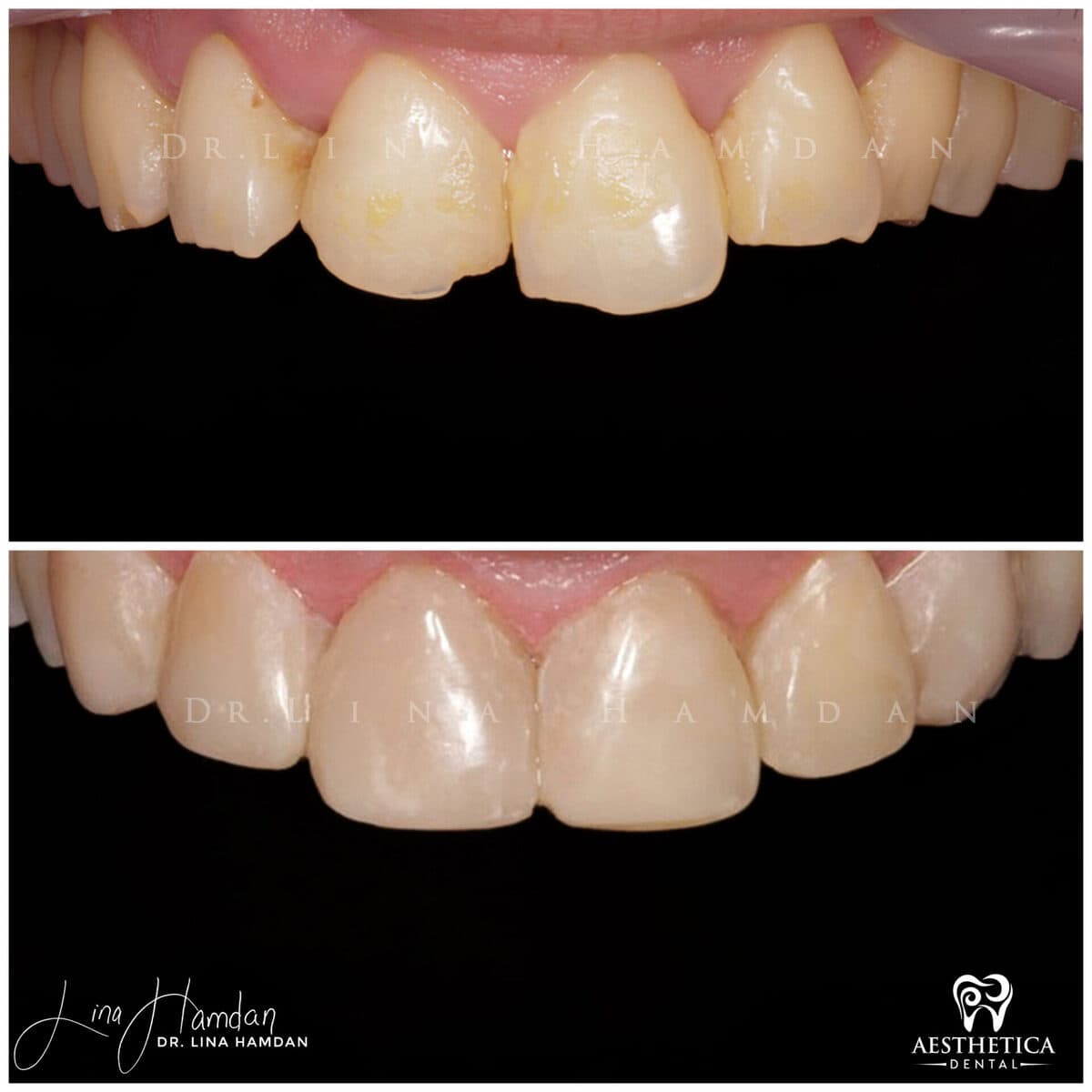 Composite bonding: anonymous case 117 from Aesthetica Dental Naperville