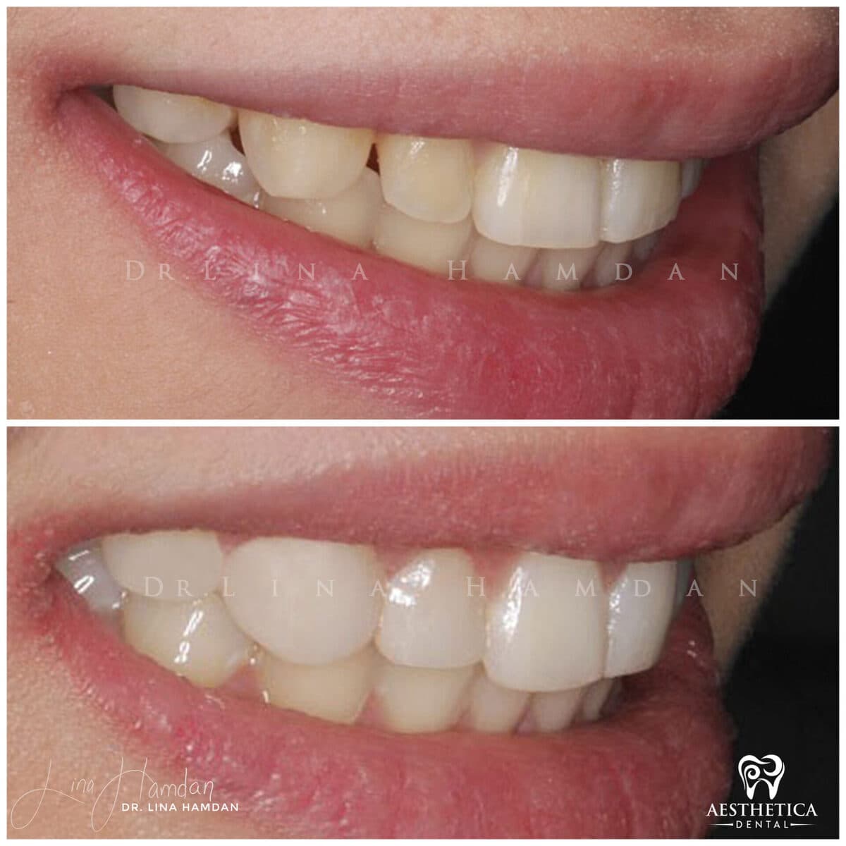 Composite bonding: anonymous case 121 from Aesthetica Dental Naperville
