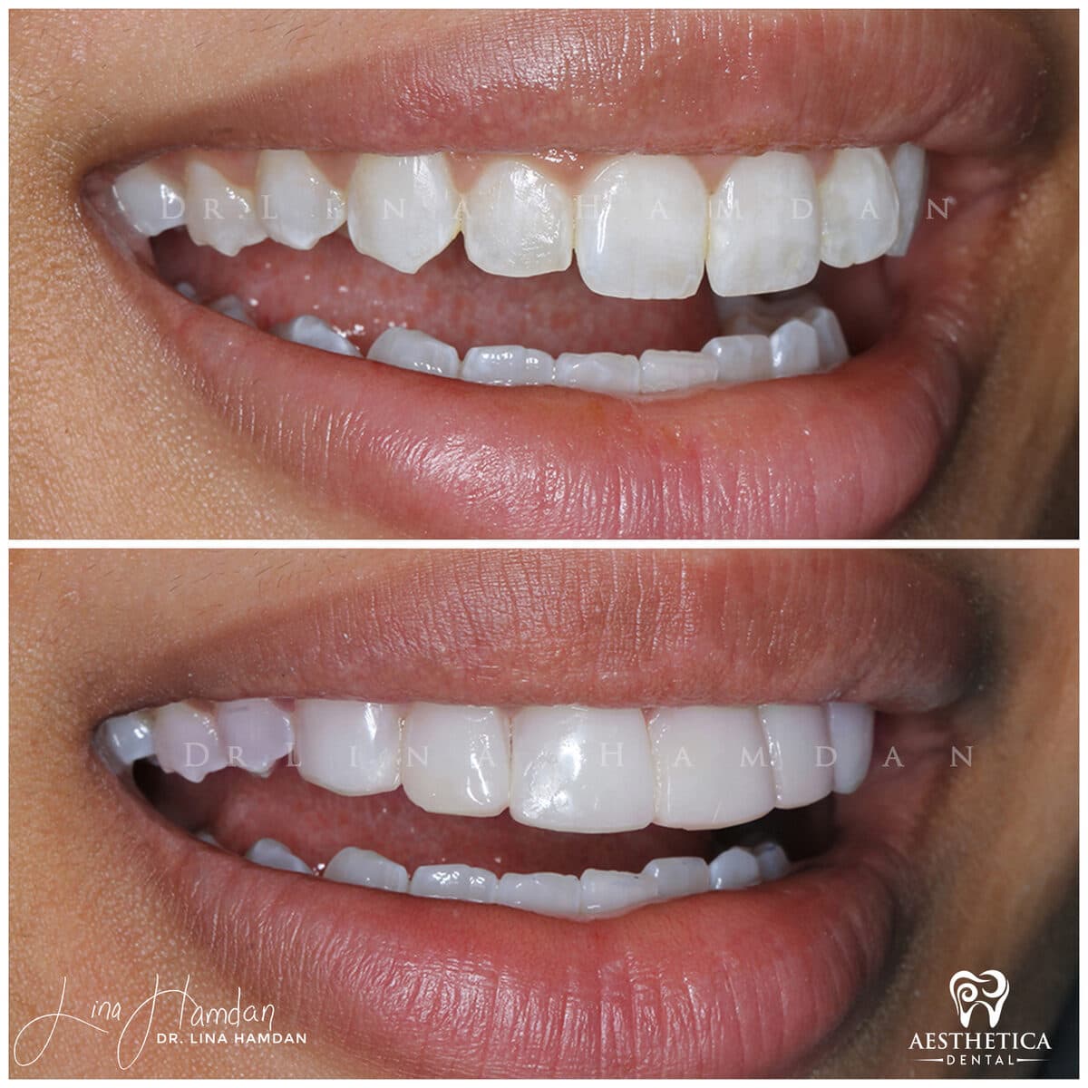 Composite bonding: anonymous case 122 from Aesthetica Dental Naperville