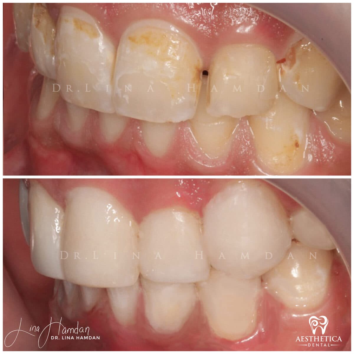 Composite bonding: anonymous case 124 from Aesthetica Dental Naperville