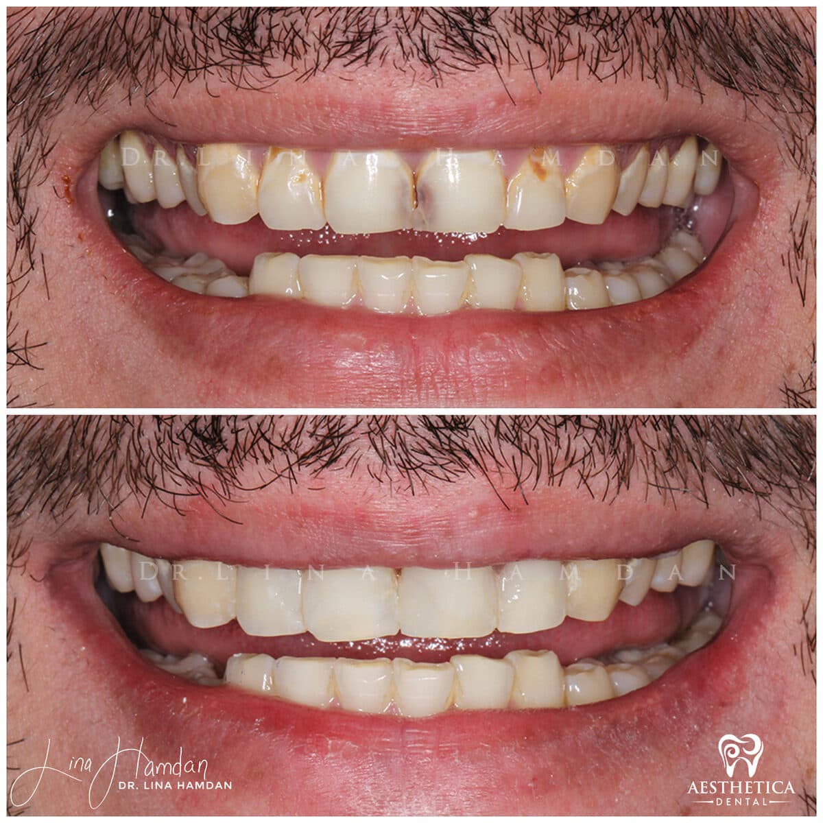 Composite bonding: anonymous case 125 from Aesthetica Dental Naperville
