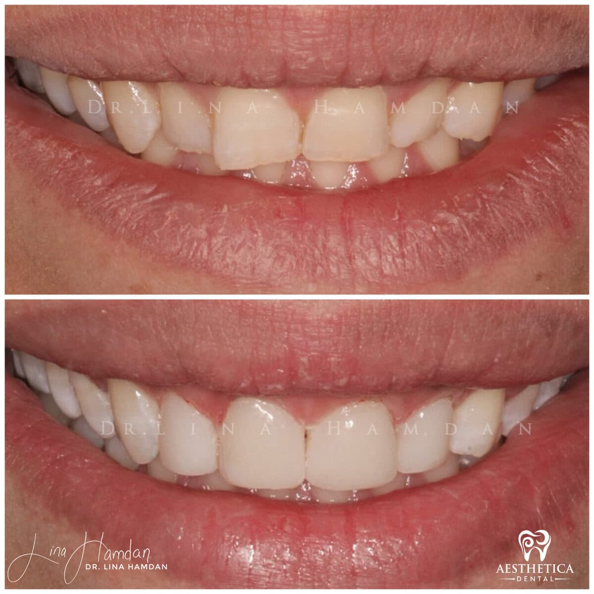Composite bonding: anonymous case 126 from Aesthetica Dental Naperville