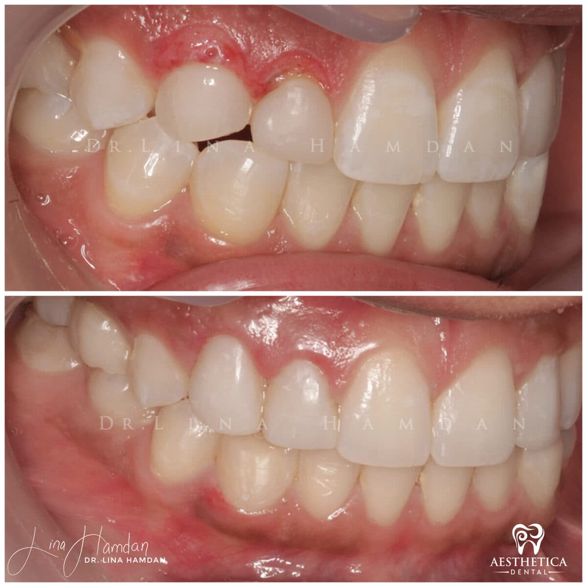 Composite bonding: anonymous case 128 from Aesthetica Dental Naperville