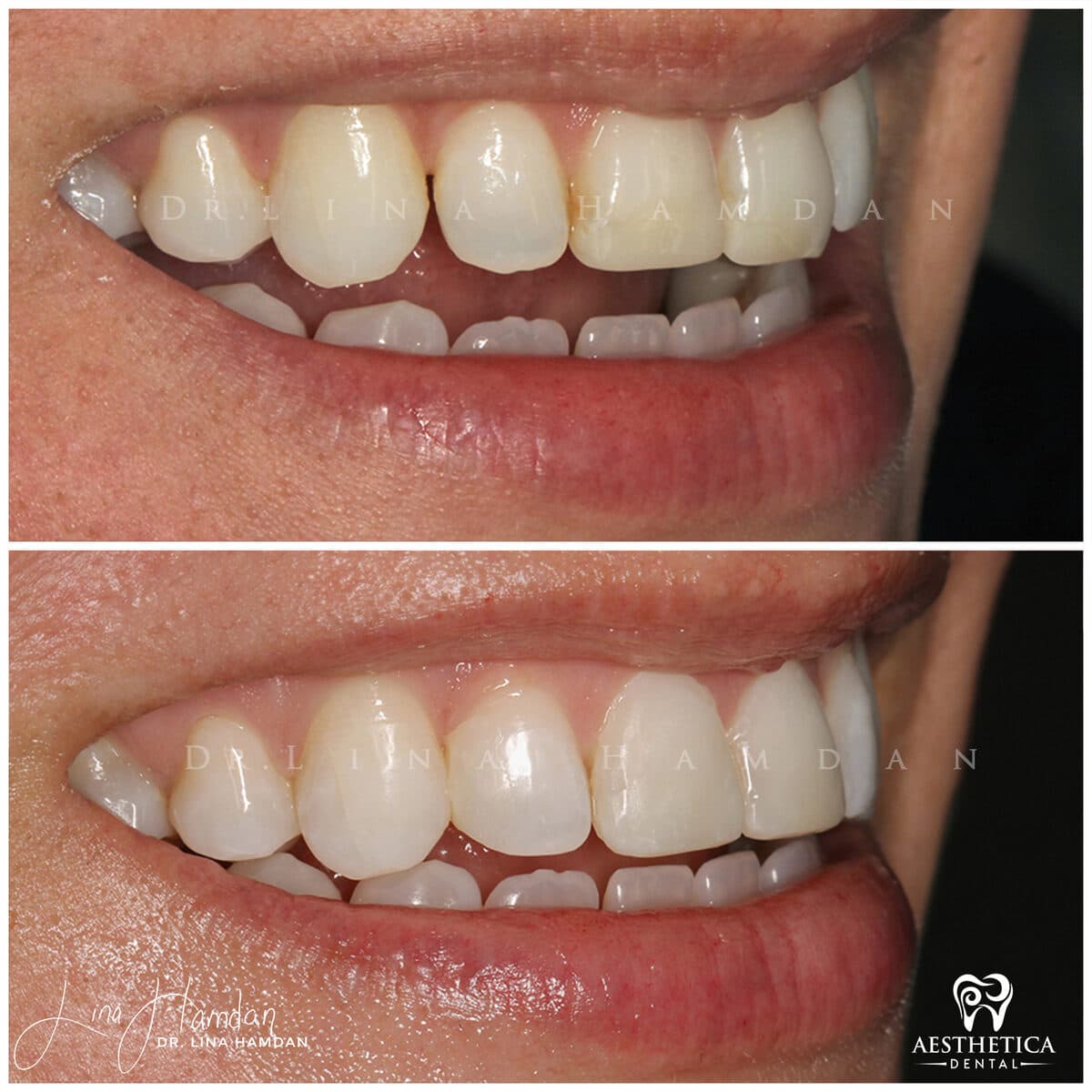 Composite bonding: anonymous case 129 from Aesthetica Dental Naperville