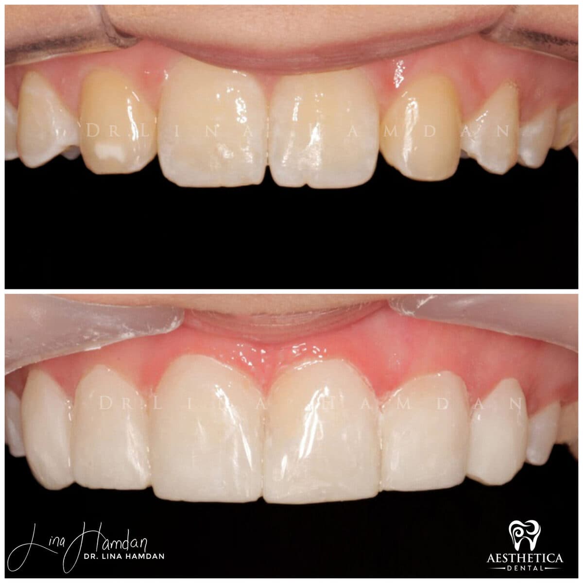 Composite bonding: anonymous case 130 from Aesthetica Dental Naperville