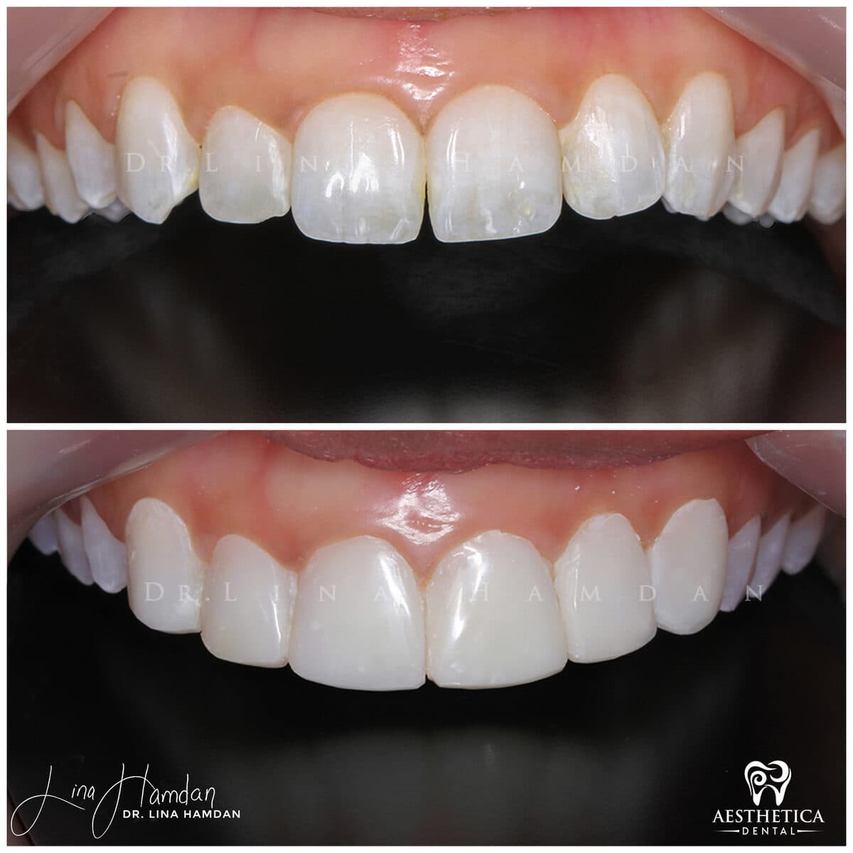 Composite bonding: anonymous case 131 from Aesthetica Dental Naperville