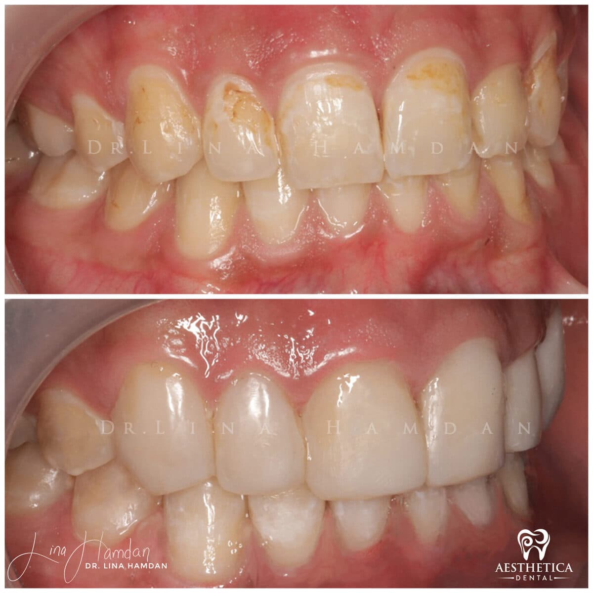 Composite bonding: anonymous case 132 from Aesthetica Dental Naperville