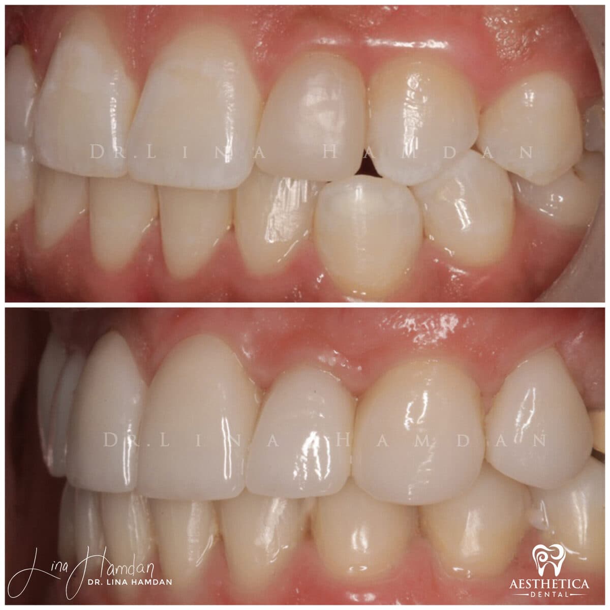 Composite bonding: anonymous case 134 from Aesthetica Dental Naperville