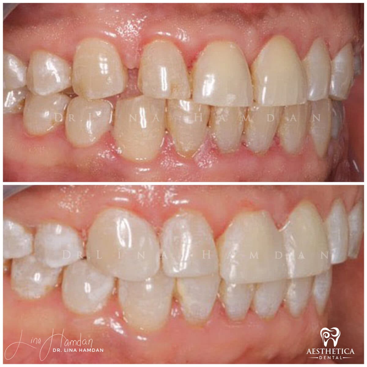 Composite bonding: anonymous case 135 from Aesthetica Dental Naperville