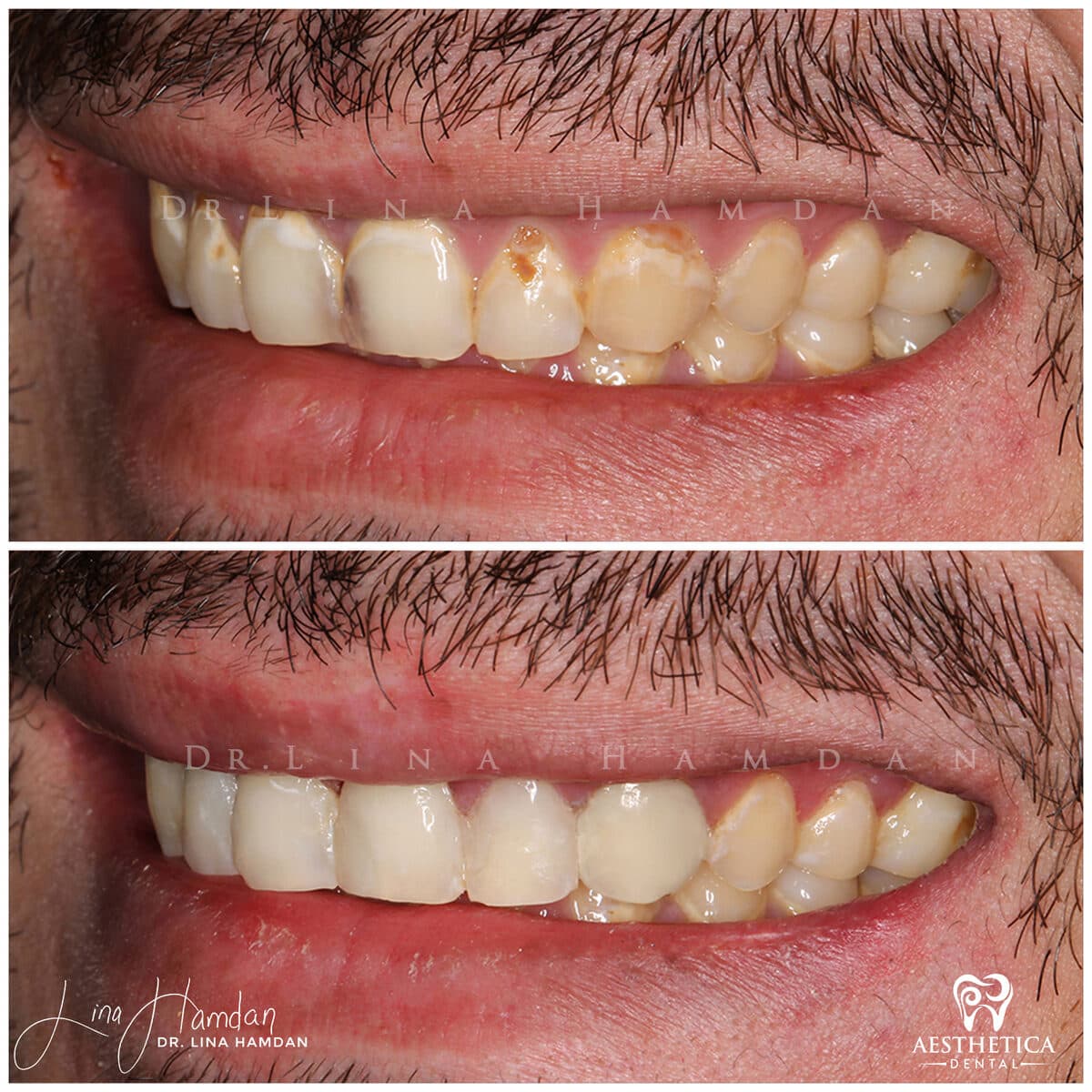 Composite bonding: anonymous case 141 from Aesthetica Dental Naperville