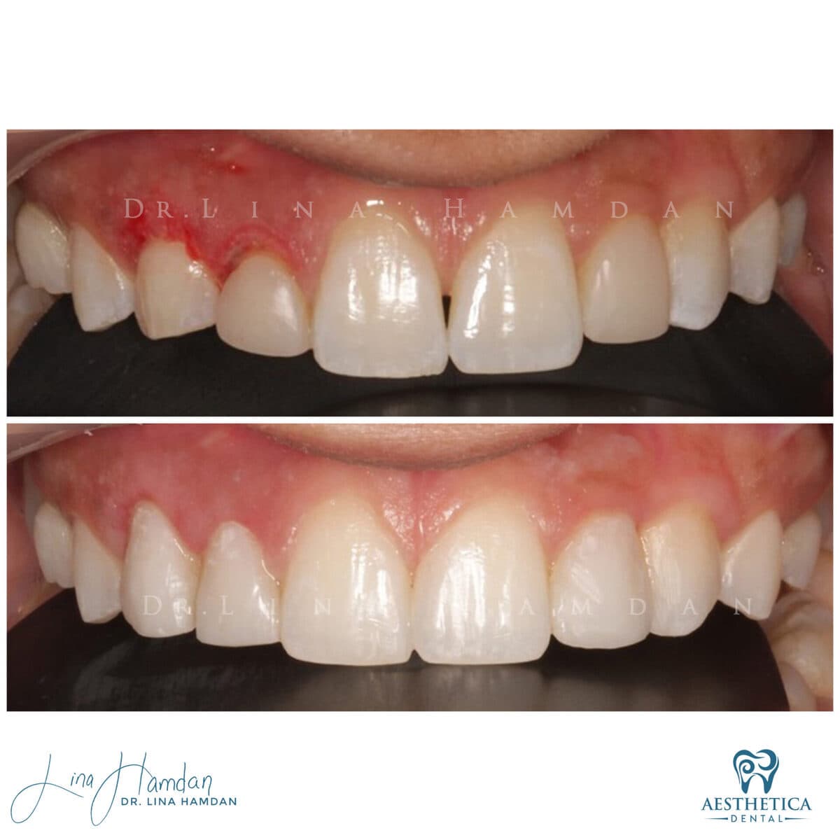 Composite bonding: anonymous case 142 from Aesthetica Dental Naperville