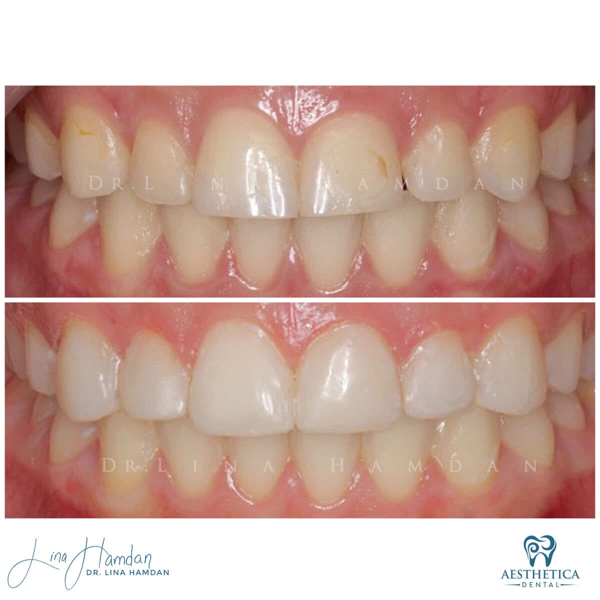 Composite bonding: anonymous case 143 from Aesthetica Dental Naperville
