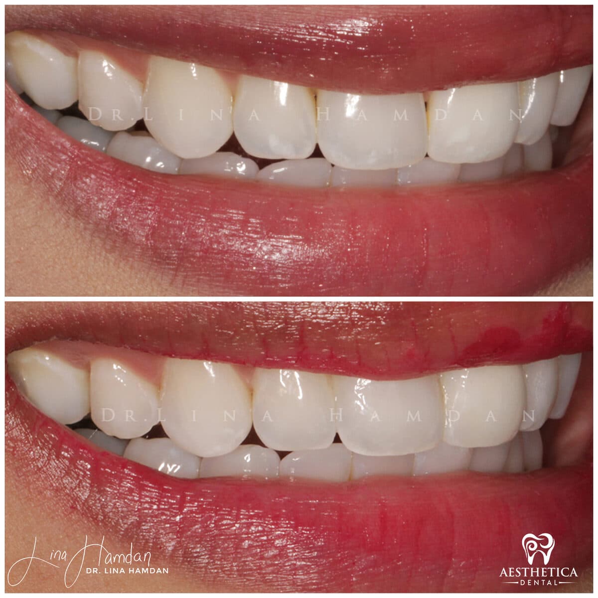 Composite bonding: anonymous case 144 from Aesthetica Dental Naperville