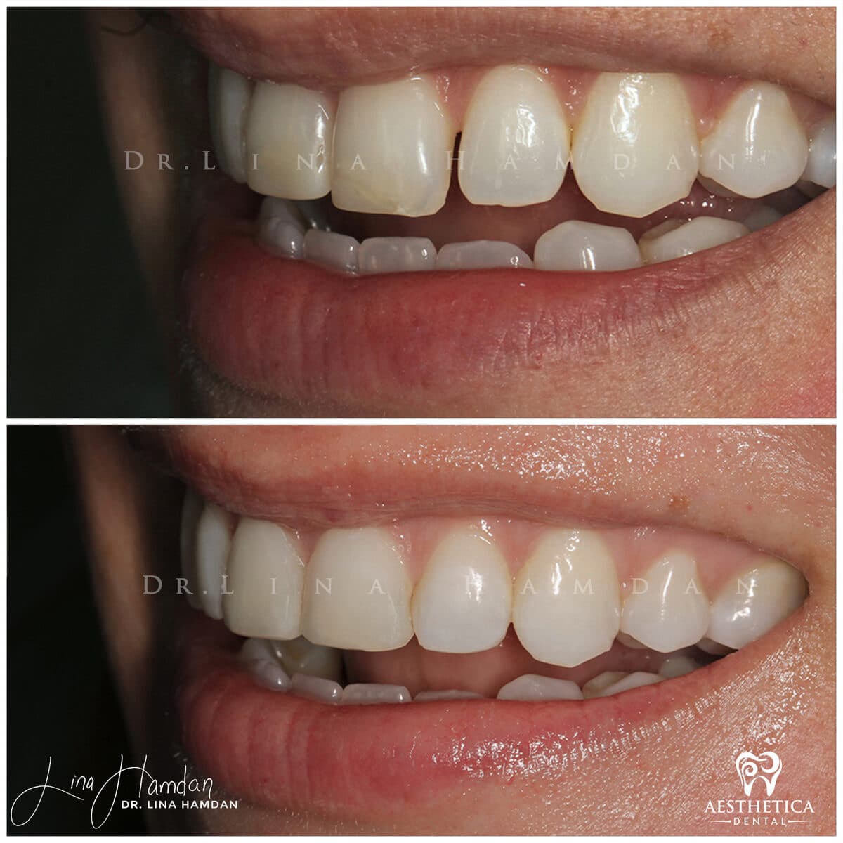Composite bonding: anonymous case 145 from Aesthetica Dental Naperville