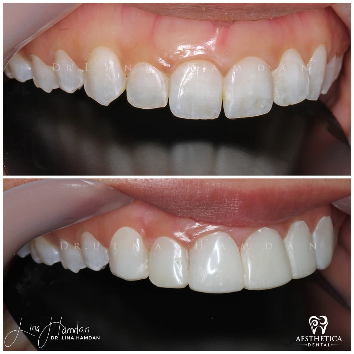 Composite bonding: anonymous case 146 from Aesthetica Dental Naperville