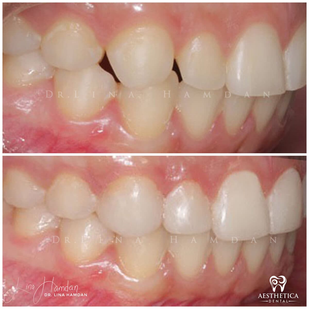 Composite bonding: anonymous case 147 from Aesthetica Dental Naperville