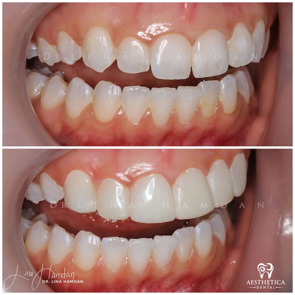 Composite bonding: anonymous case 148 from Aesthetica Dental Naperville