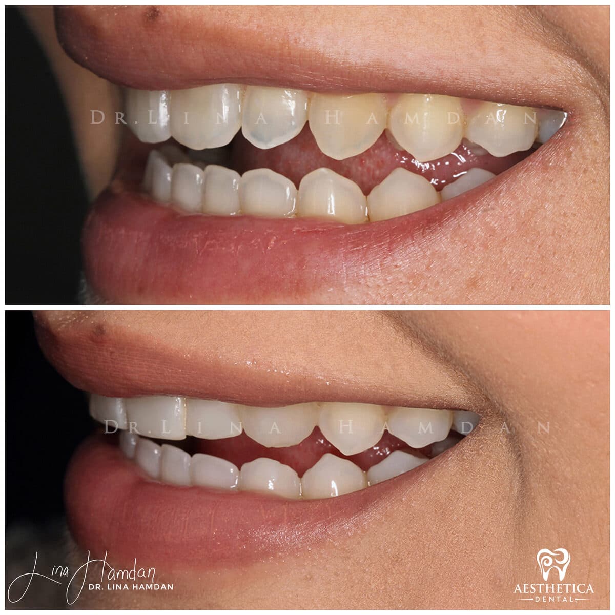Composite bonding: anonymous case 149 from Aesthetica Dental Naperville