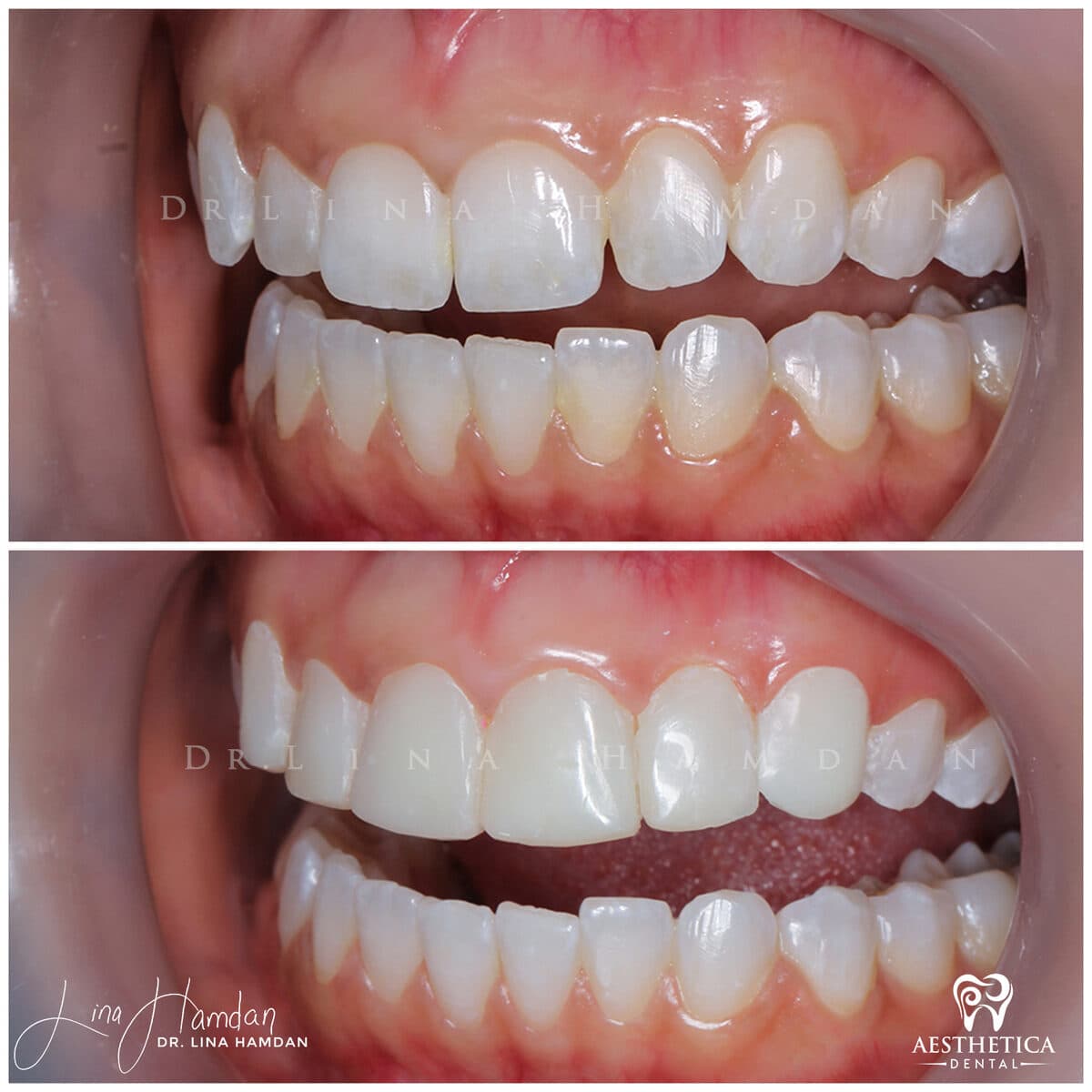Composite bonding: anonymous case 152 from Aesthetica Dental Naperville