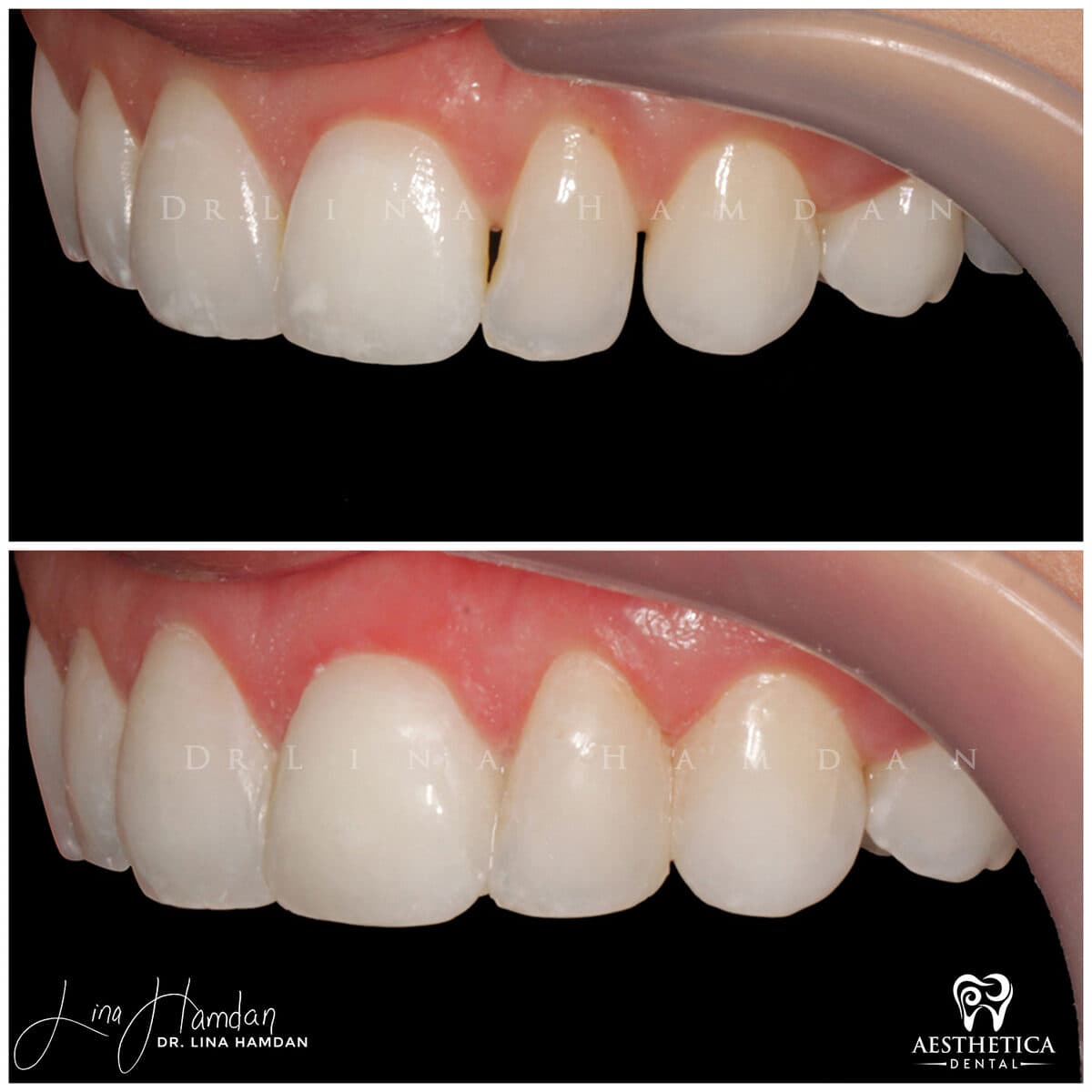Composite bonding: anonymous case 153 from Aesthetica Dental Naperville