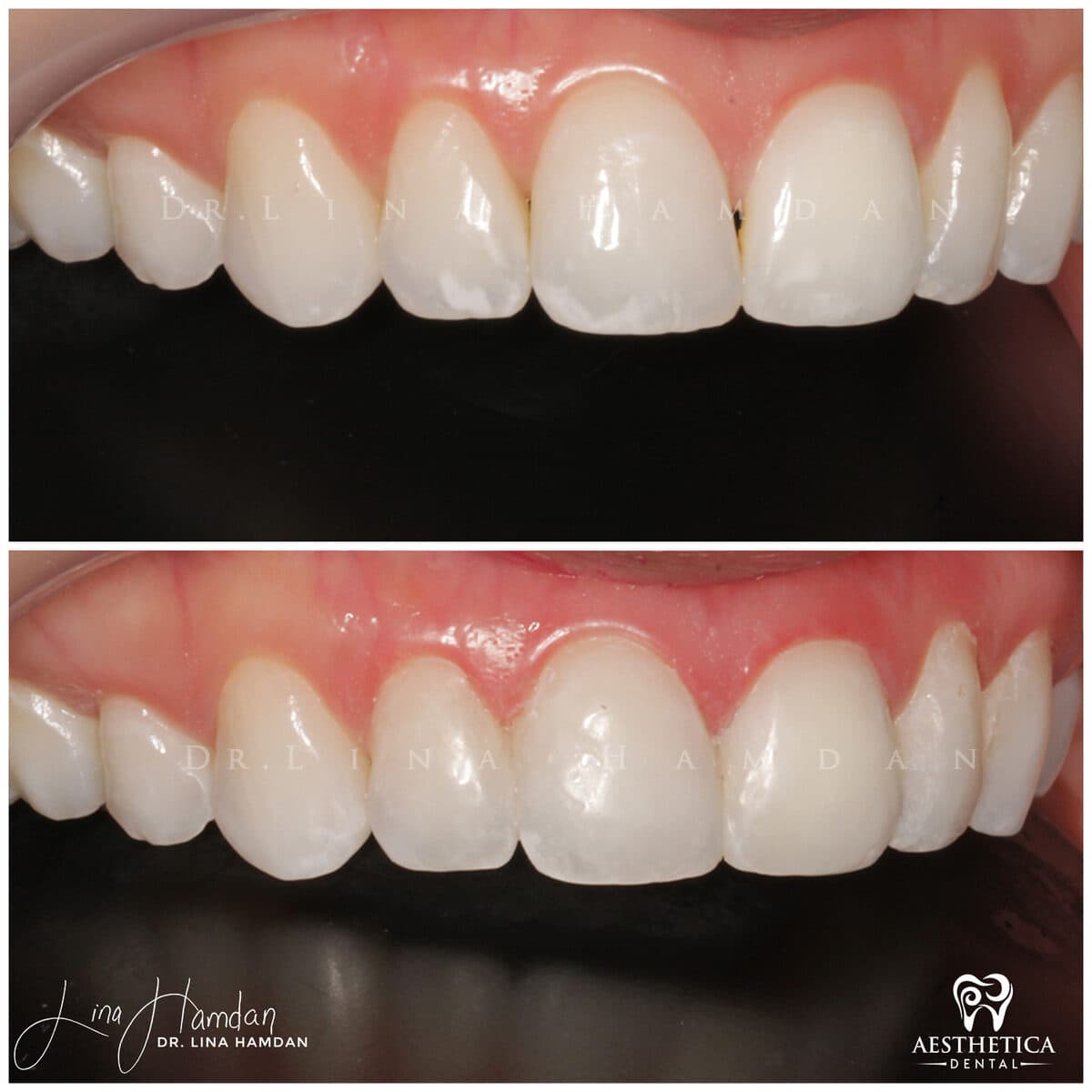 Composite bonding: anonymous case 156 from Aesthetica Dental Naperville