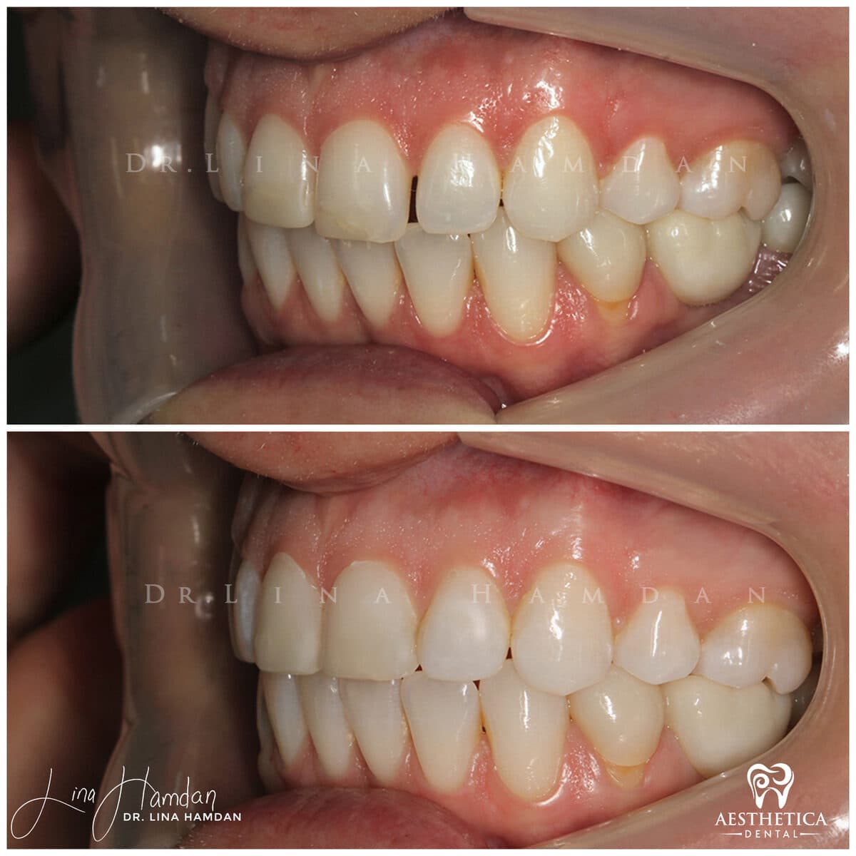 Composite bonding: anonymous case 157 from Aesthetica Dental Naperville