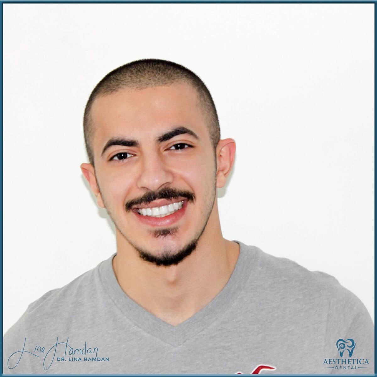 Composite bonding: anonymous case 160 from Aesthetica Dental Naperville