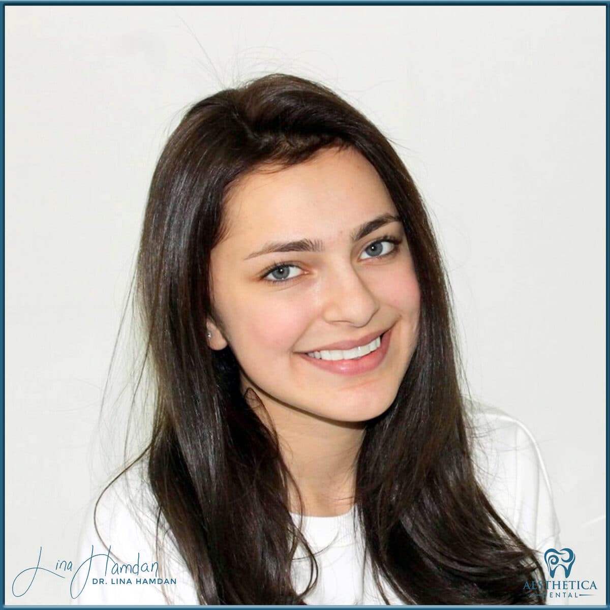 Composite bonding: anonymous case 162 from Aesthetica Dental Naperville