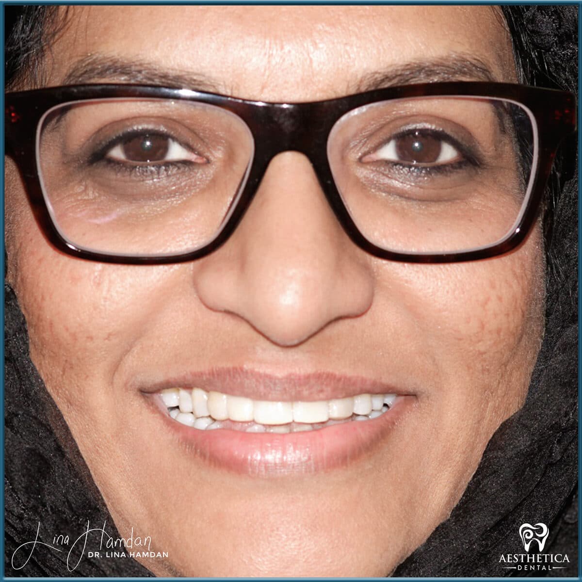 Composite bonding: anonymous case 163 from Aesthetica Dental Naperville