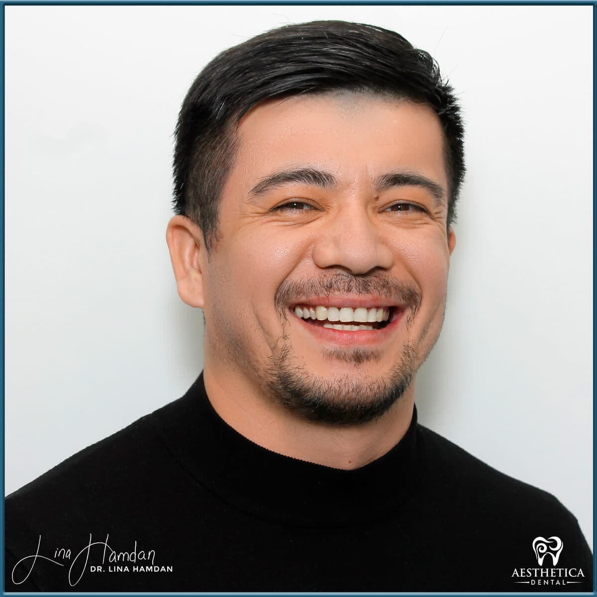 Composite bonding: anonymous case 166 from Aesthetica Dental Naperville