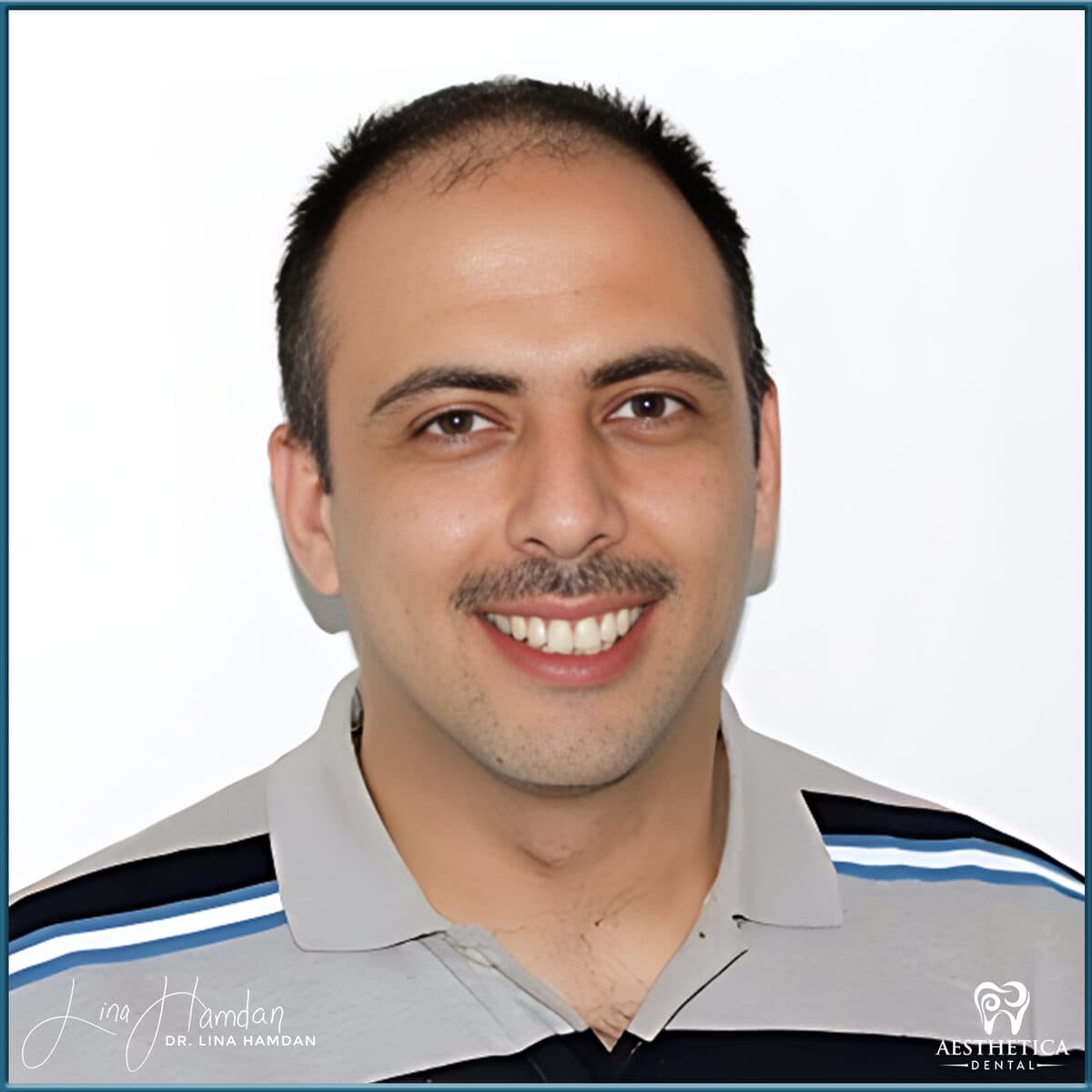 Composite bonding: anonymous case 167 from Aesthetica Dental Naperville