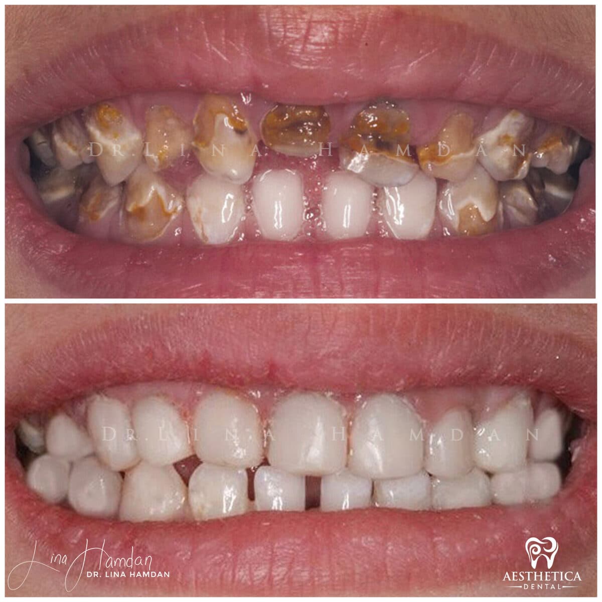 Children’s dentistry.: anonymous before-and-after case photograph from Aesthetica Dental Naperville