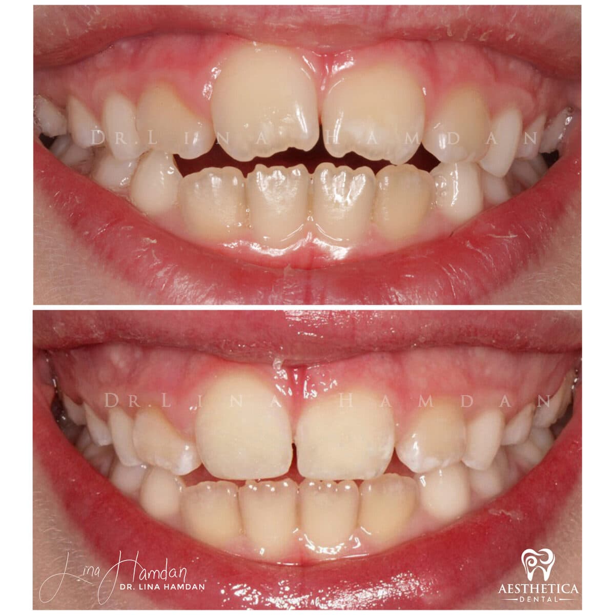 Pediatric dentistry visit, anonymous patient at Aesthetica Dental Naperville (case 2, 2025-05-1-2-1)