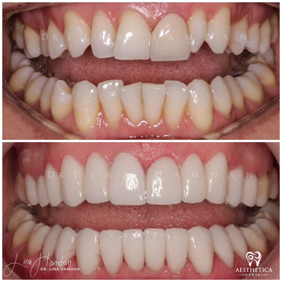 Inman aligners.: anonymous before-and-after case photograph from Aesthetica Dental Naperville