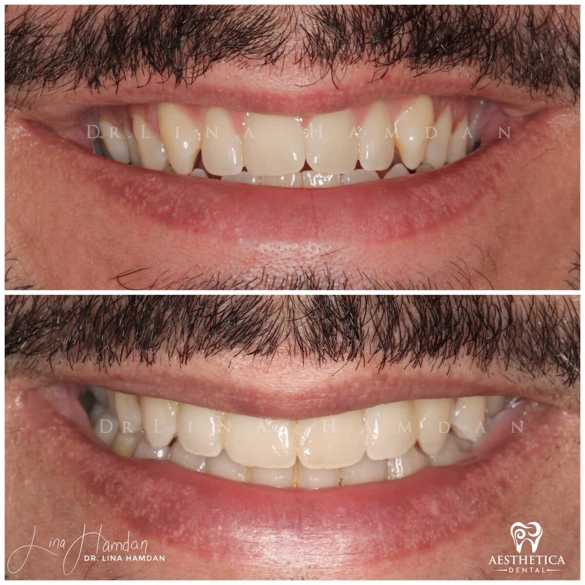 Clear aligners, quietly handled.: anonymous before-and-after case photograph from Aesthetica Dental Naperville