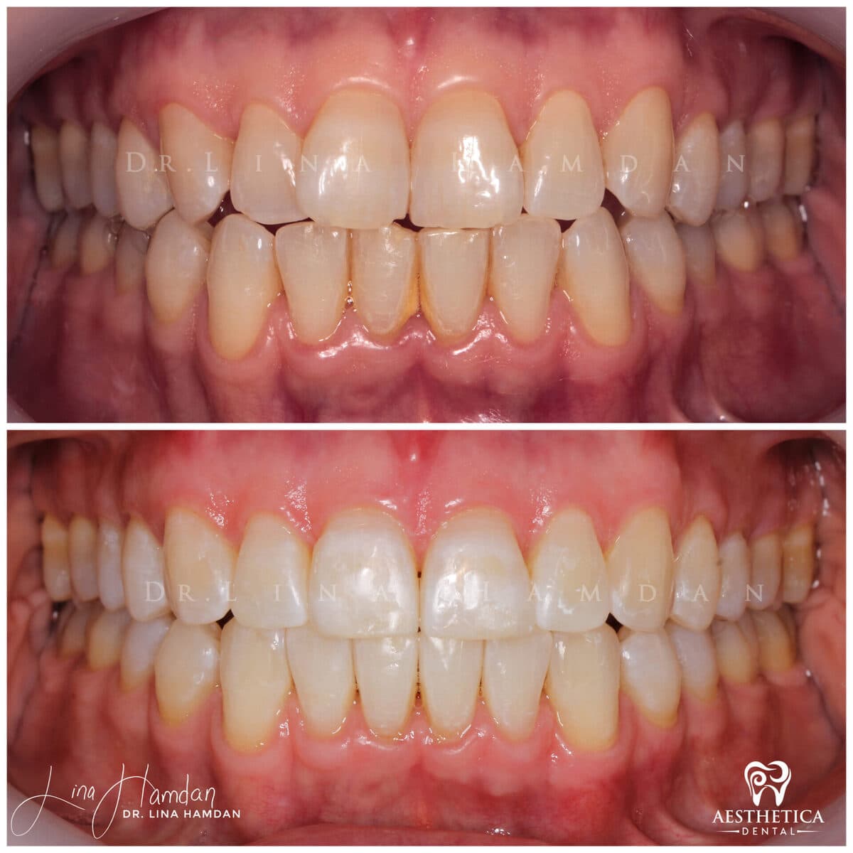 Clear aligners, quietly handled: anonymous case 13 from Aesthetica Dental Naperville