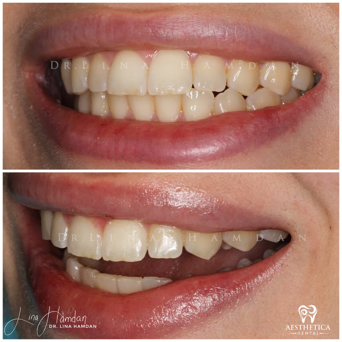 Clear aligners, quietly handled: anonymous case 16 from Aesthetica Dental Naperville