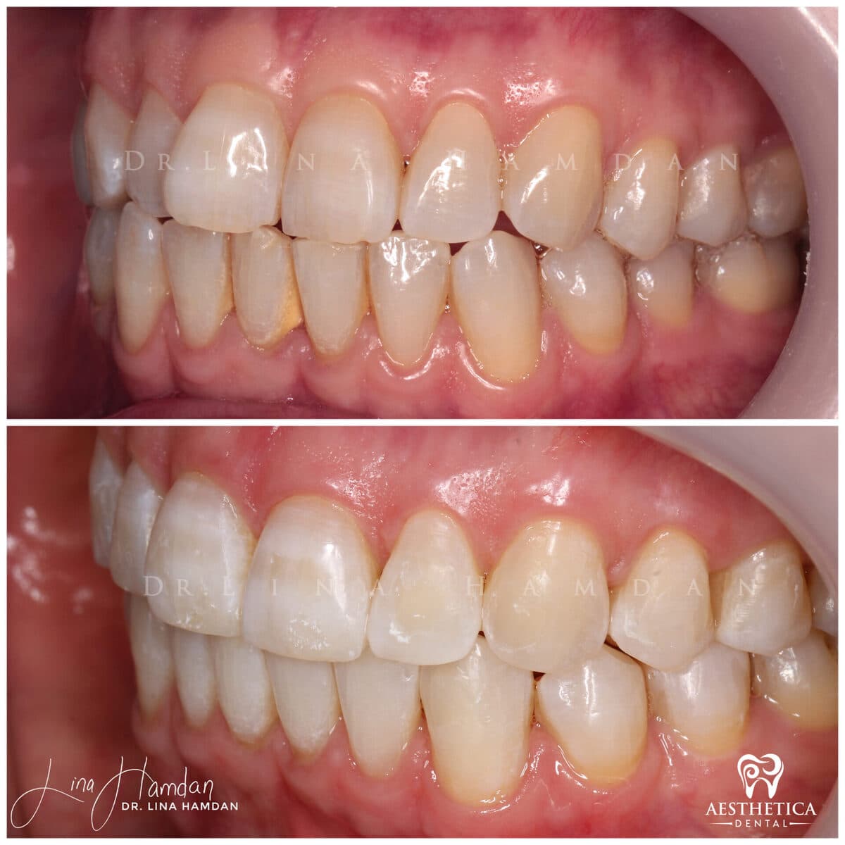 Clear aligners, quietly handled: anonymous case 18 from Aesthetica Dental Naperville