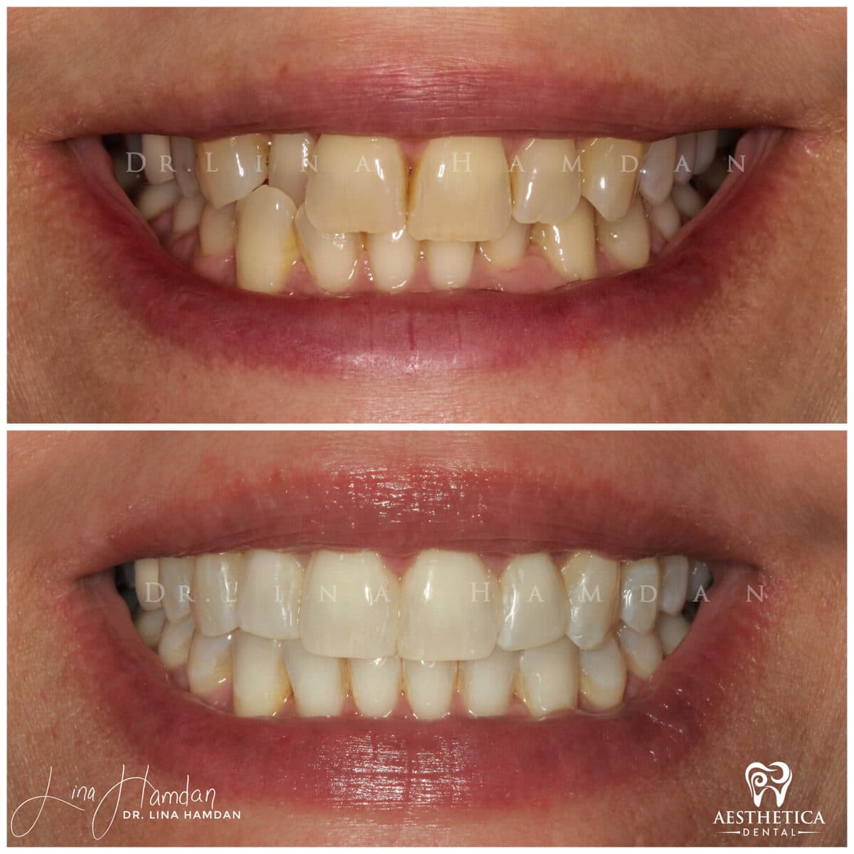 Clear aligners, quietly handled: anonymous case 19 from Aesthetica Dental Naperville